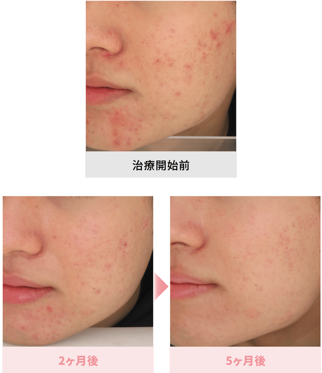イソトレチノイン（アクネトレント）症例画像1