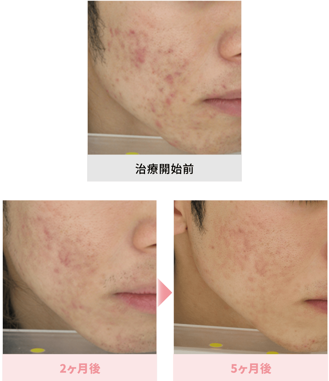 イソトレチノイン（アクネトレント）症例画像2